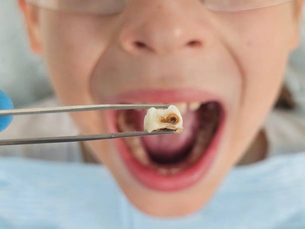 Best Emergency Treatment for Toothache in Califon, NJ